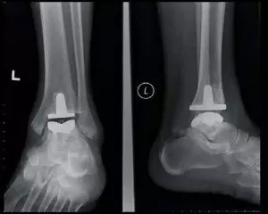 Ayak Bileği Protezinde En İyi Doktor