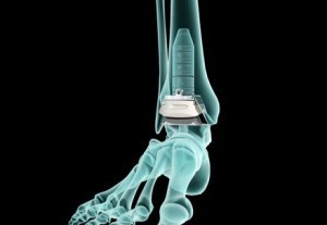 Ayak Bileği Protezi Ameliyatını Yapan En İyi Doktor